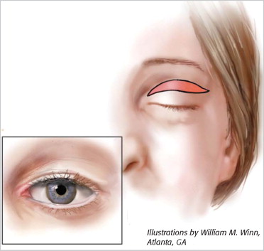 Ptosis Repair