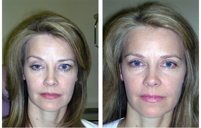 Ptosis Repair