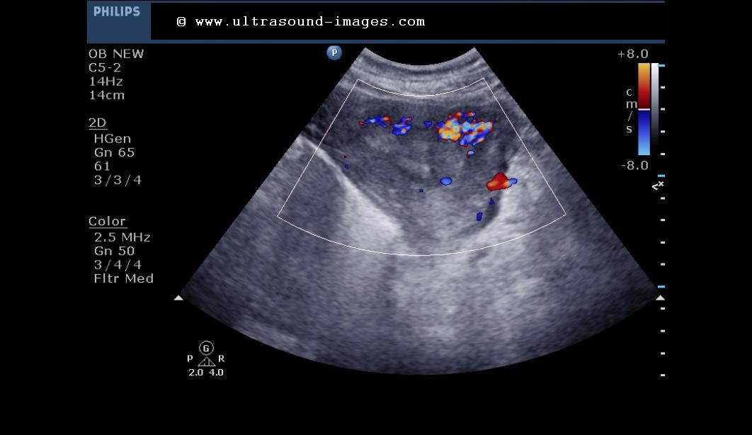 Retained Products Of Conception On Ultrasound