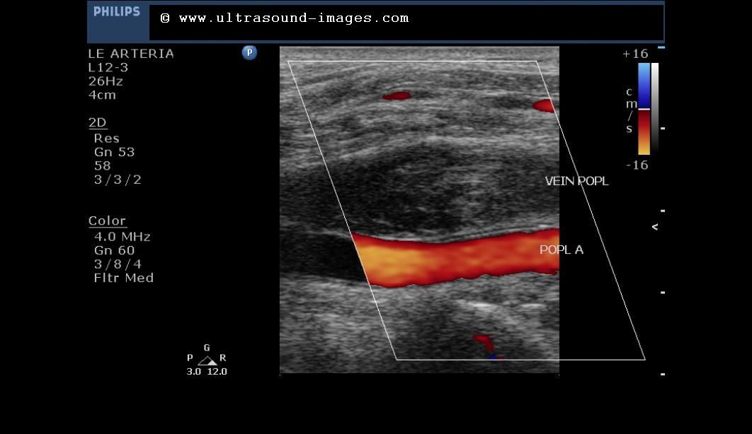 Retained Products Of Conception On Ultrasound