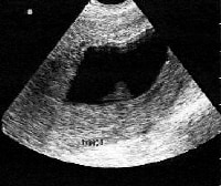 Retained Products Of Conception On Ultrasound