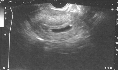 Retained Products Of Conception On Ultrasound