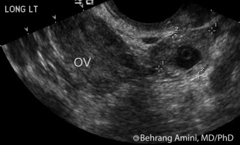 Retained Products Of Conception On Ultrasound