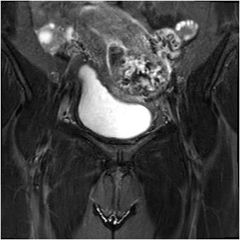 Retained Products Of Conception Radiographics