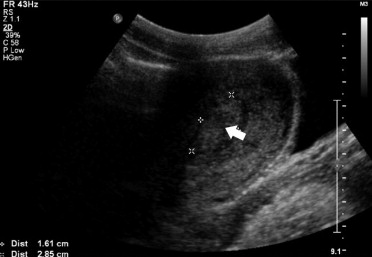 Retained Products Of Conception Radiographics