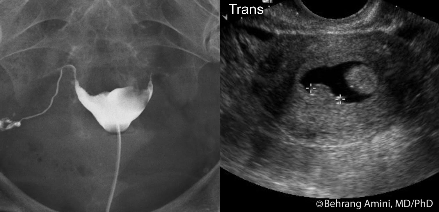 Retained Products Of Conception Symptoms