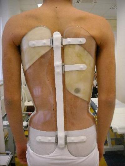 Scoliosis Braces For Adults