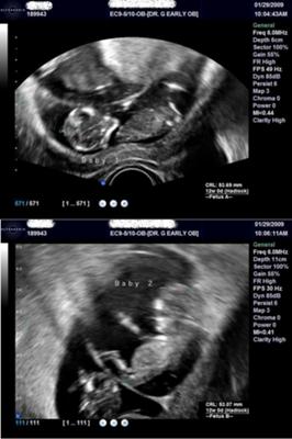 Twins At 12 Weeks Pregnant Pictures